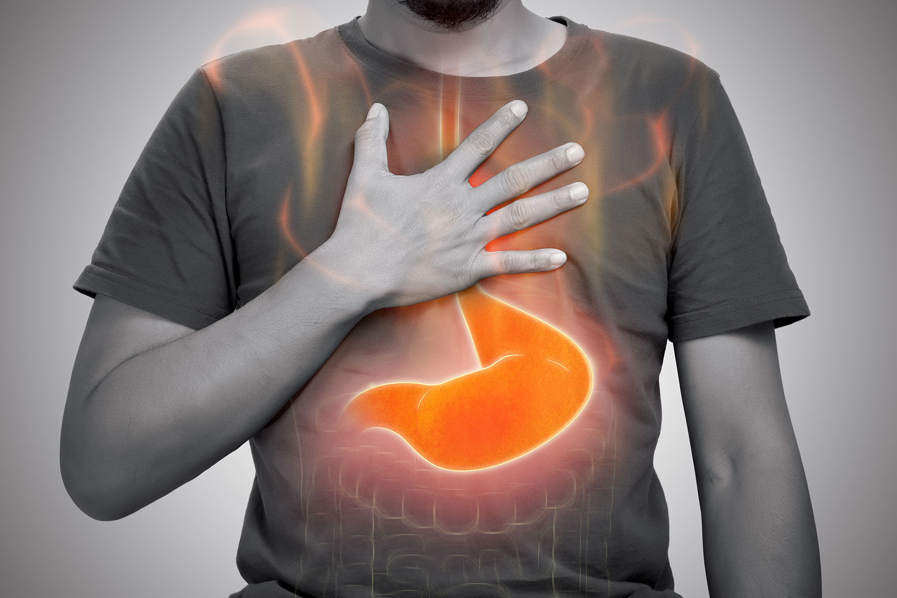 Le reflux gastro-œsophagien (RGO) - Consultation DR Juan AMARIS spécialiste gastro-enterologie